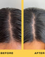 Before and after comparison of hairline treatment on a person's head.