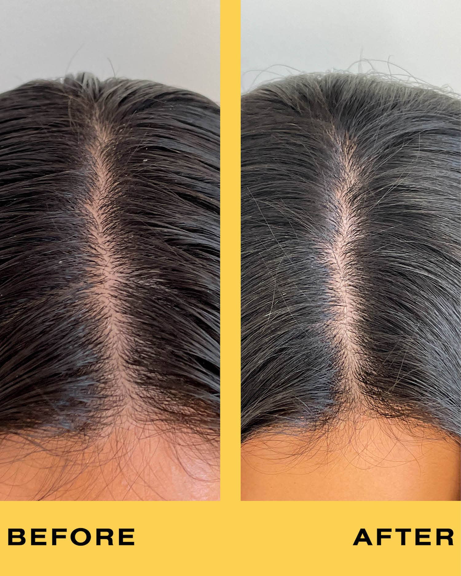 Before and after comparison of hairline treatment on a person's head.